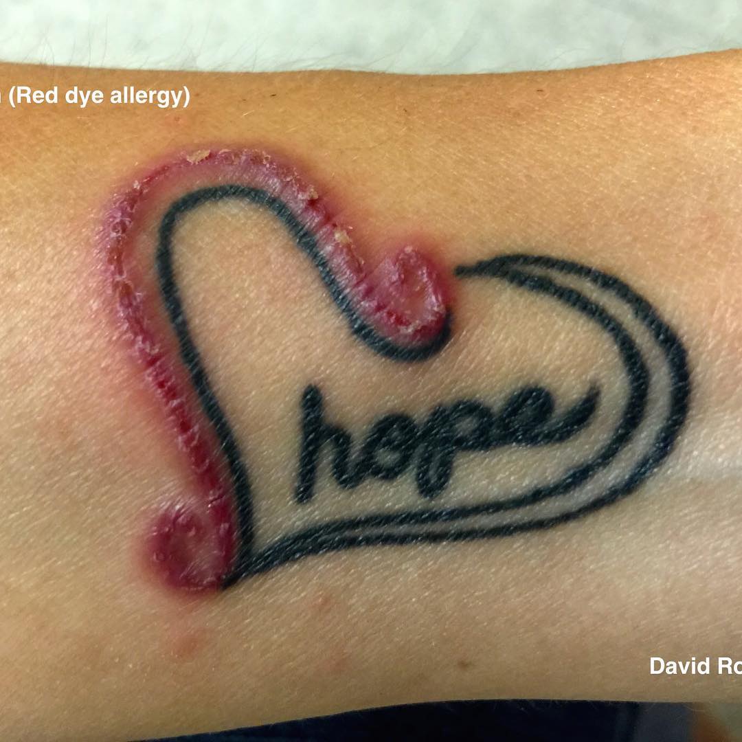 allergia tattoo photocredit @derm doctor dave